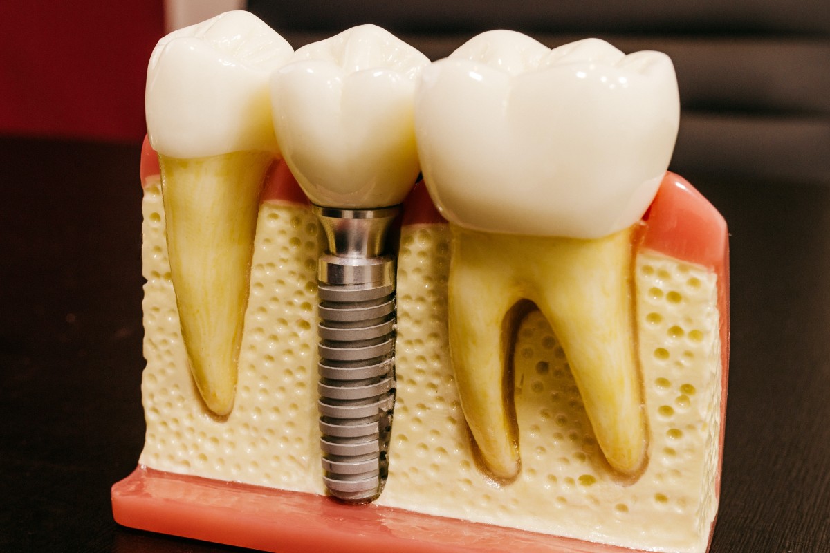 Fog implantátum az Oktán fogklinikán